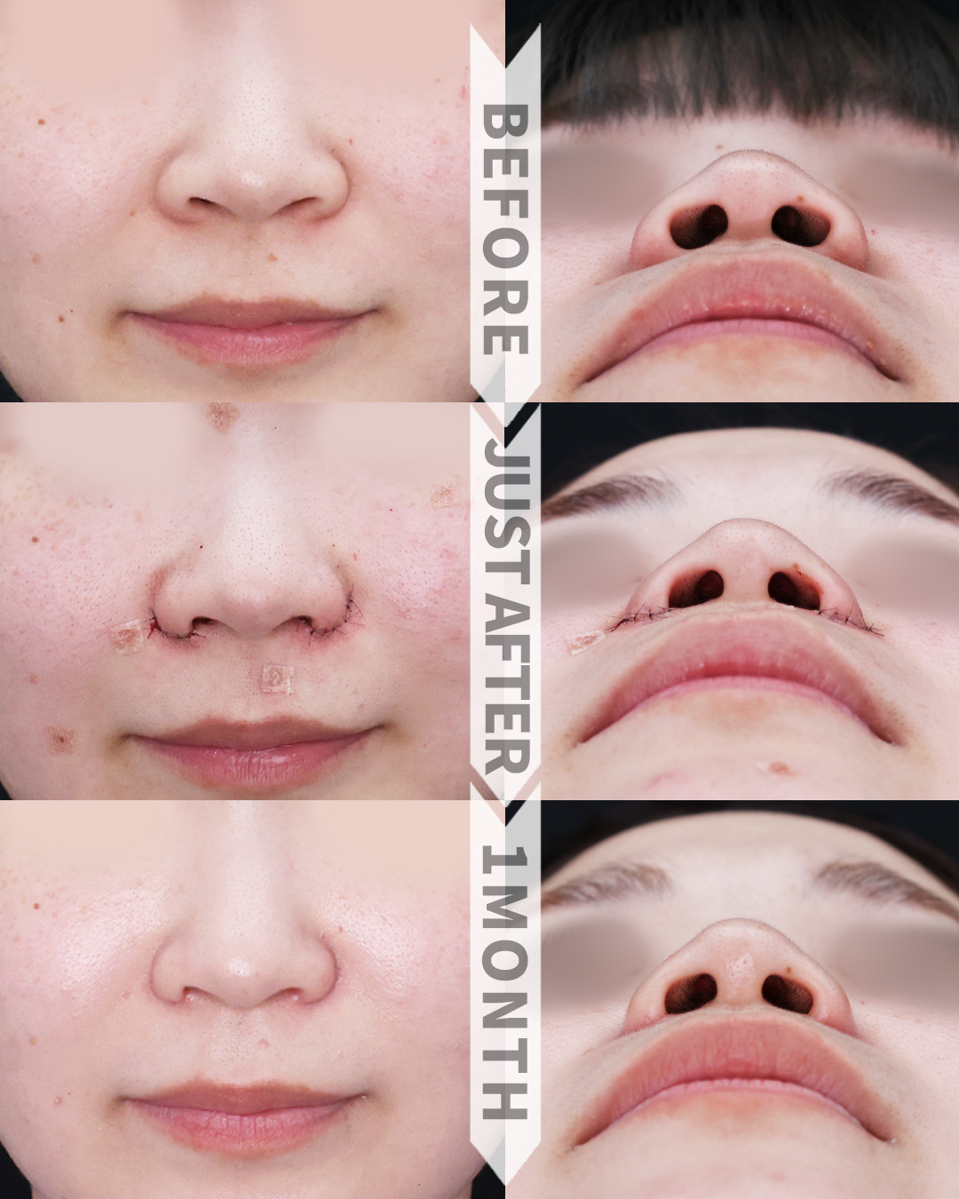 TAC式 鼻翼縮小術（小鼻縮小）の症例写真 施術前後 