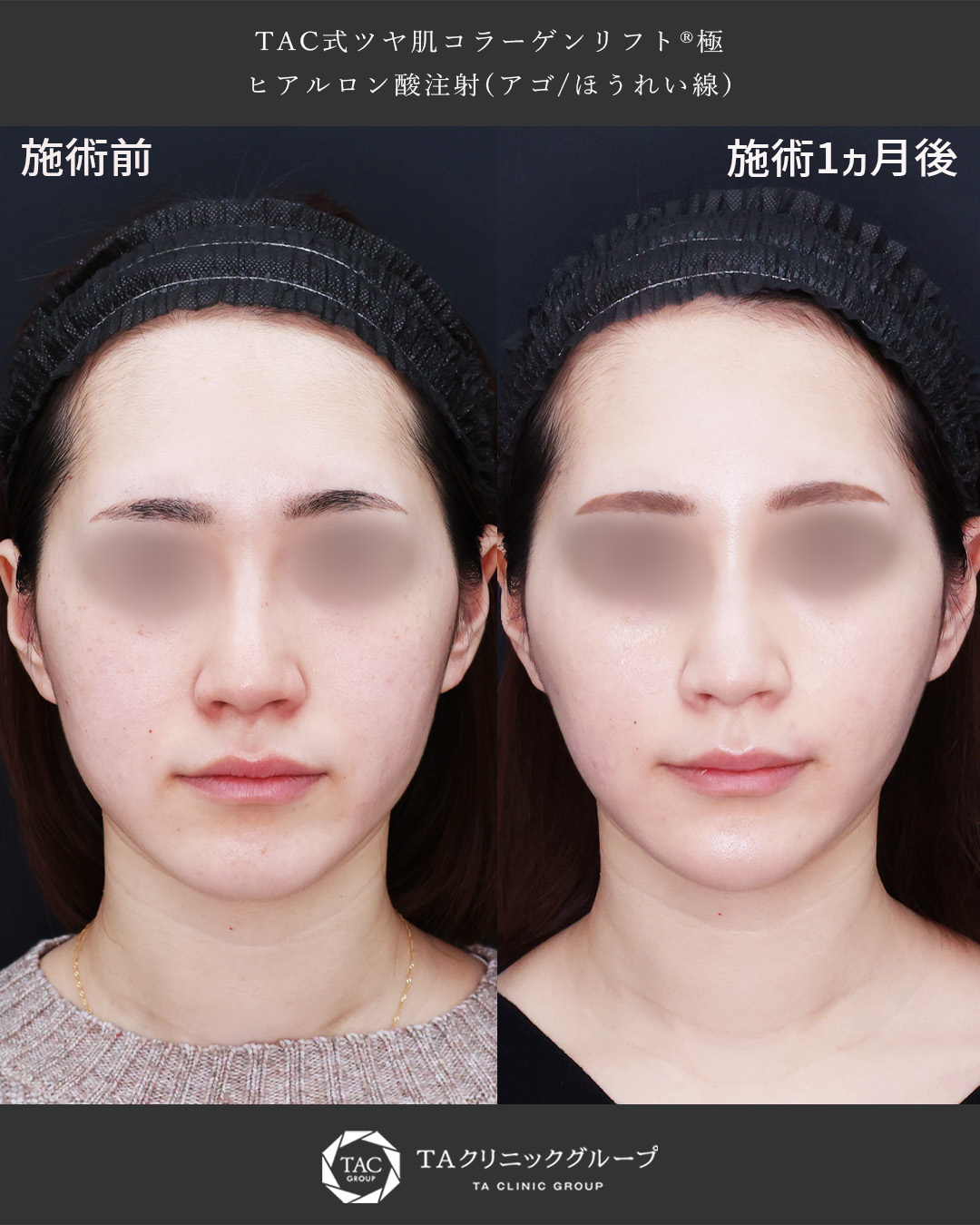 【糸リフト×ヒアルロン酸】ナチュラルに輪郭洗練◎たるみケアは若いうちから