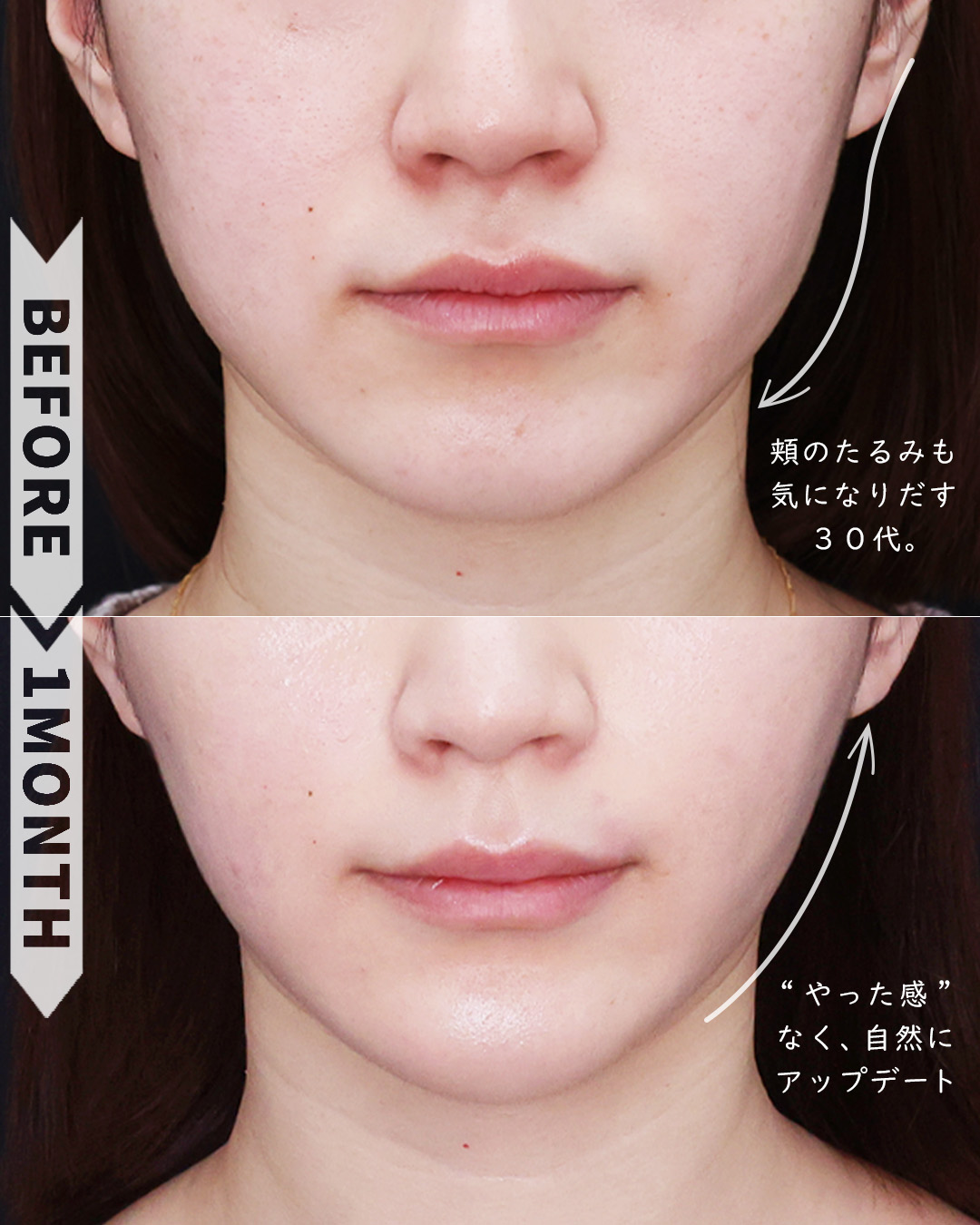 ほうれい線のヒアルロン酸注射/顎のヒアルロン酸注射/TAC式 ツヤ肌コラーゲンリフト®の症例写真 施術前後 