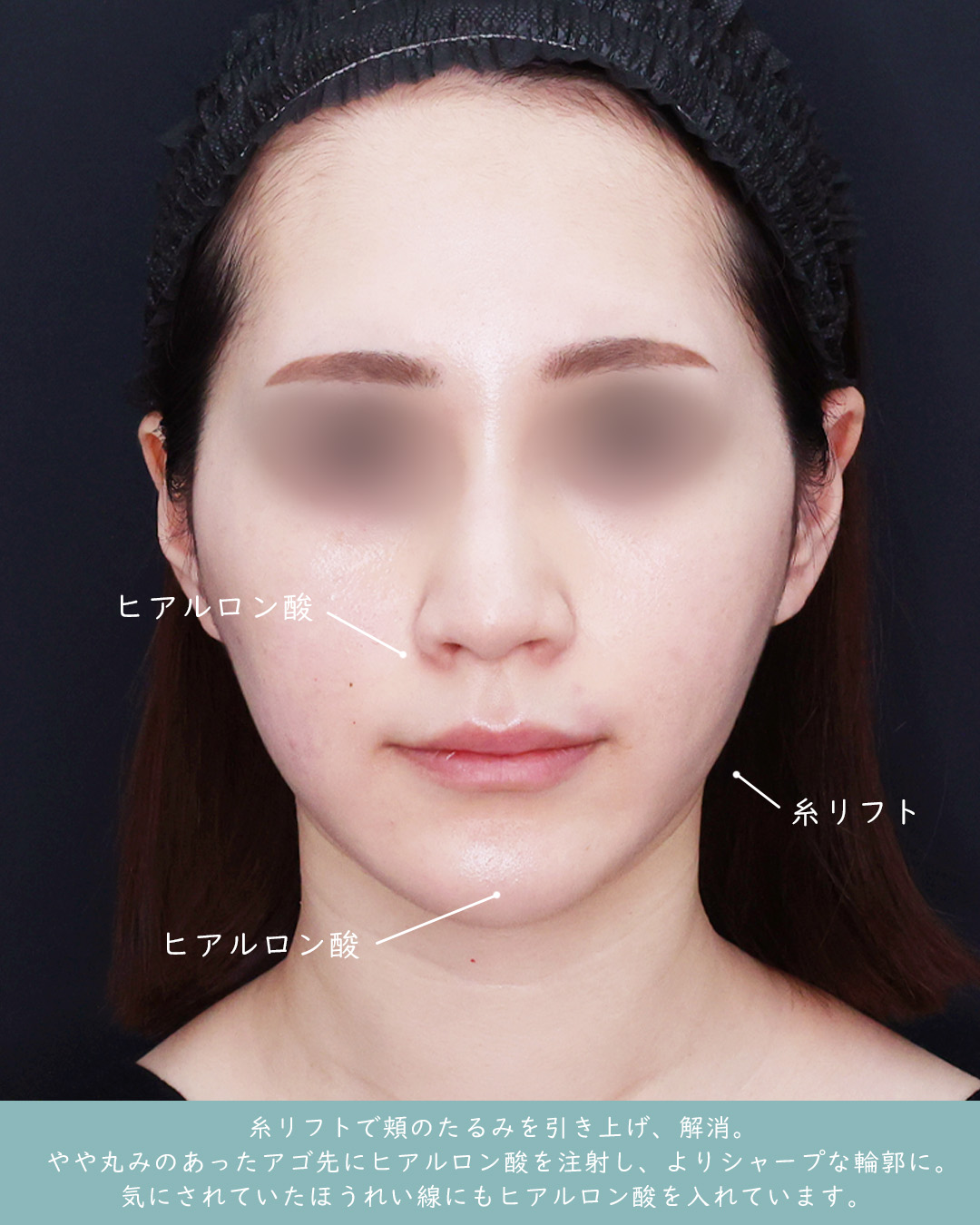 ほうれい線のヒアルロン酸注射/顎のヒアルロン酸注射/TAC式 ツヤ肌コラーゲンリフト®の症例写真 施術前後 