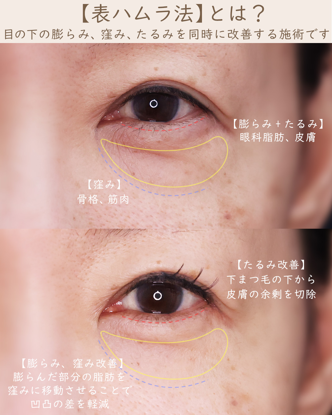 下眼瞼切開術（クマ・たるみとり）の症例写真 施術前後 