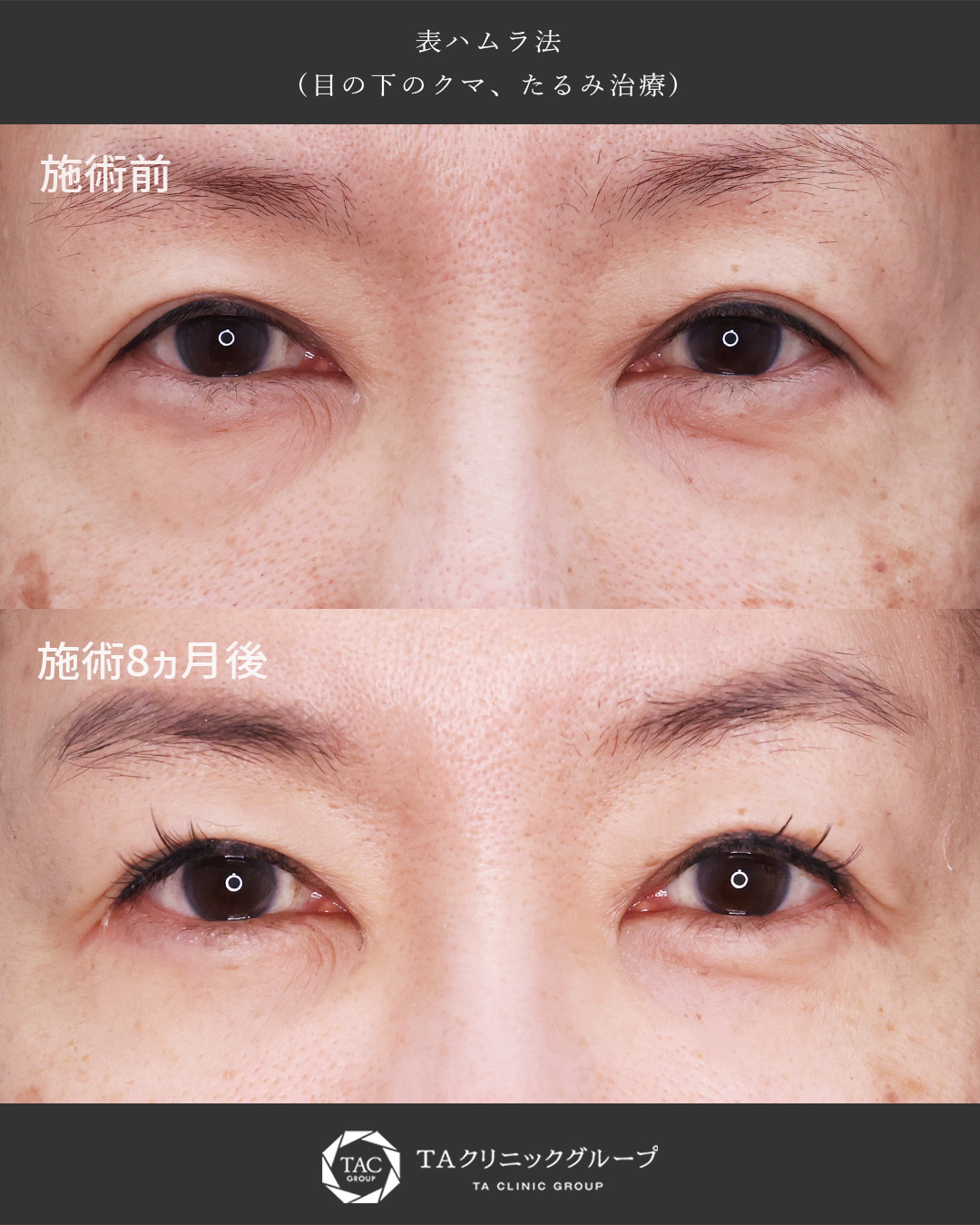 たるみ・膨らみ・窪みをまとめて改善【表ハムラ法】