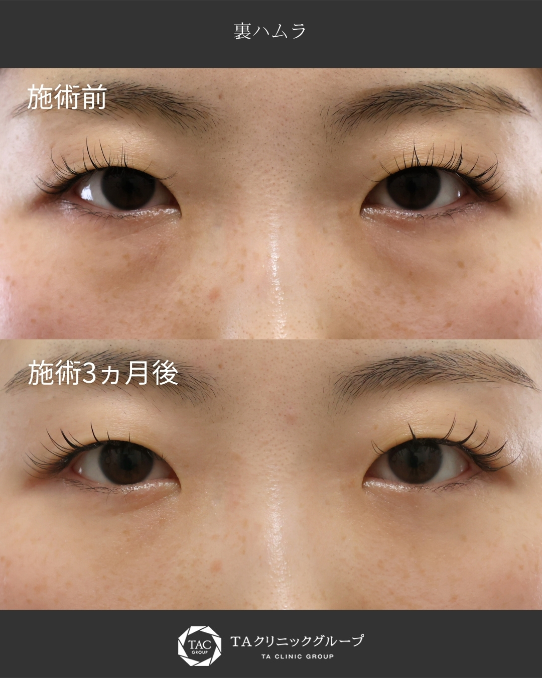 《裏ハムラ》下瞼を若々しく！