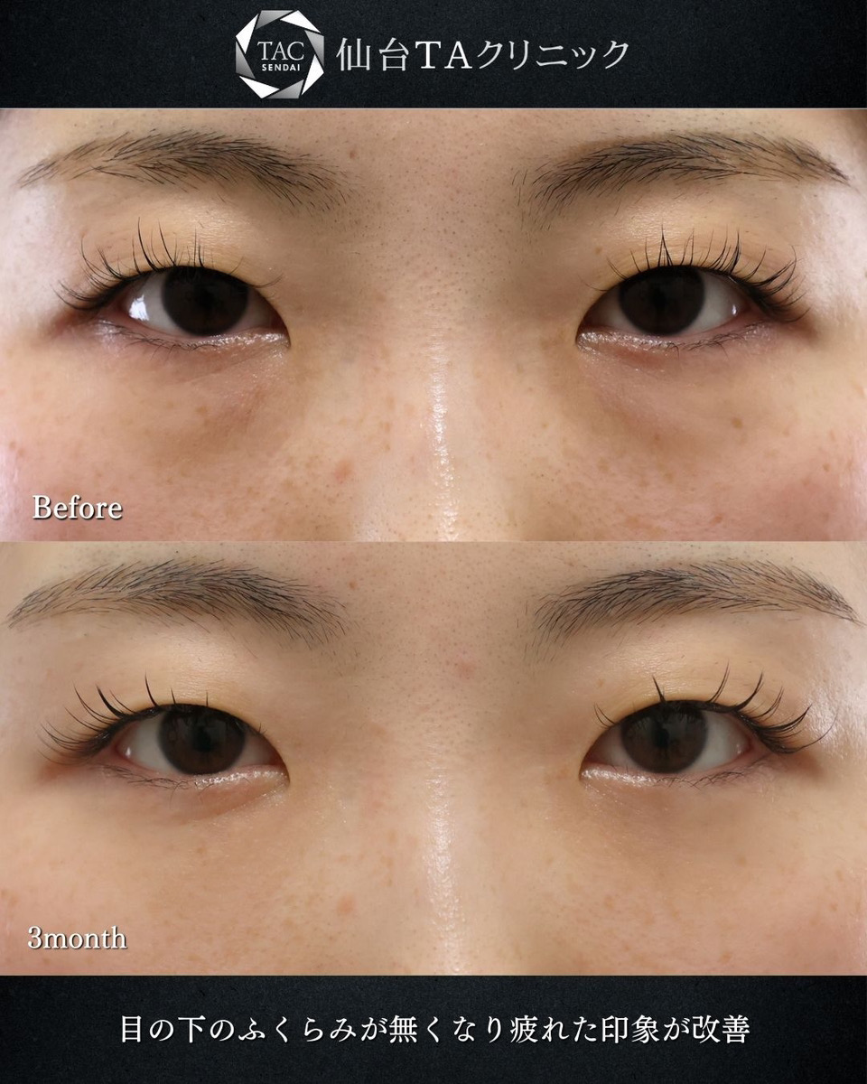 下眼瞼脱脂術（目の下のたるみ取り・目の下の脂肪ふくらみ取り）の症例写真 施術前後 