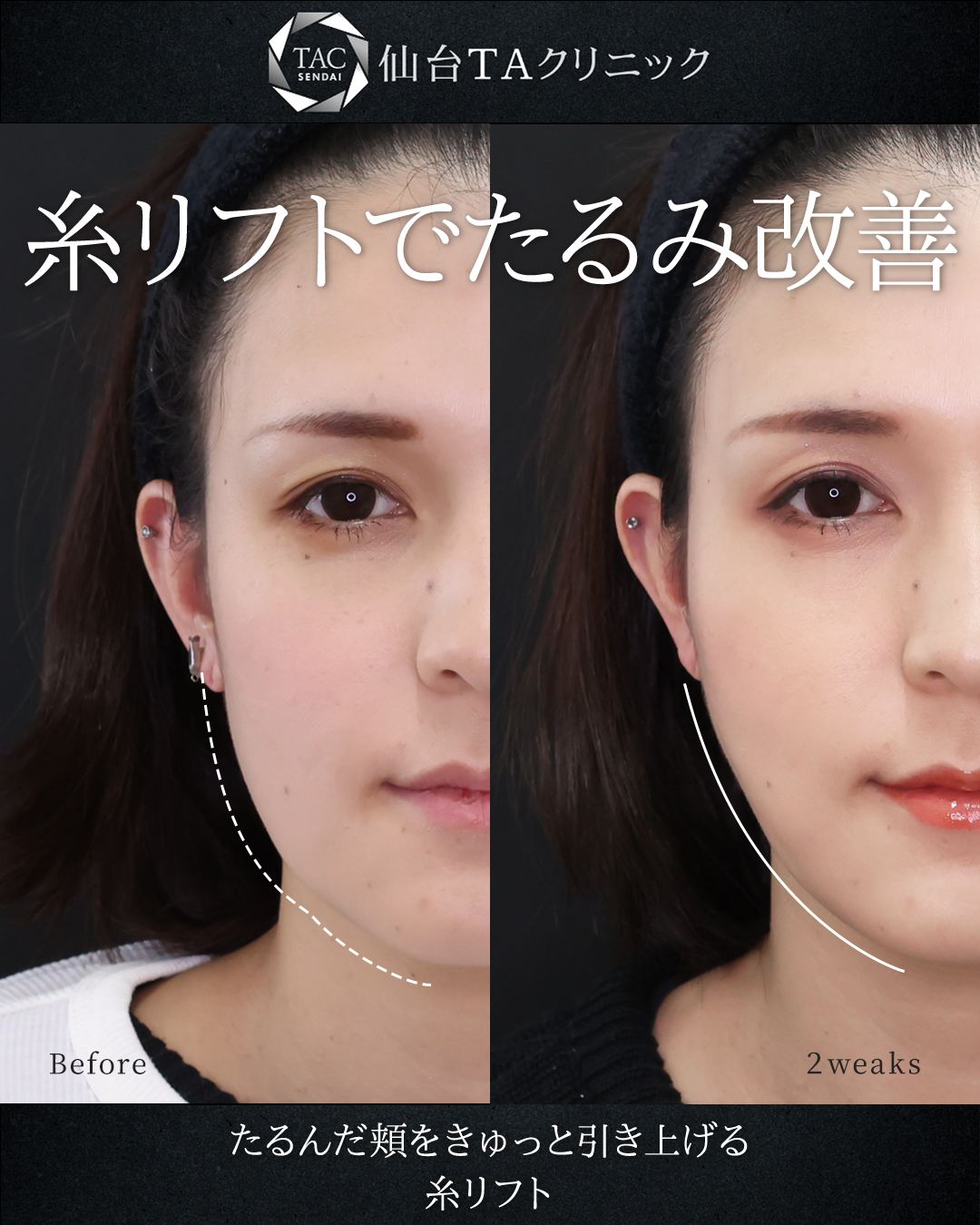 TAC式 ツヤ肌コラーゲンリフト®の症例写真 施術前後 