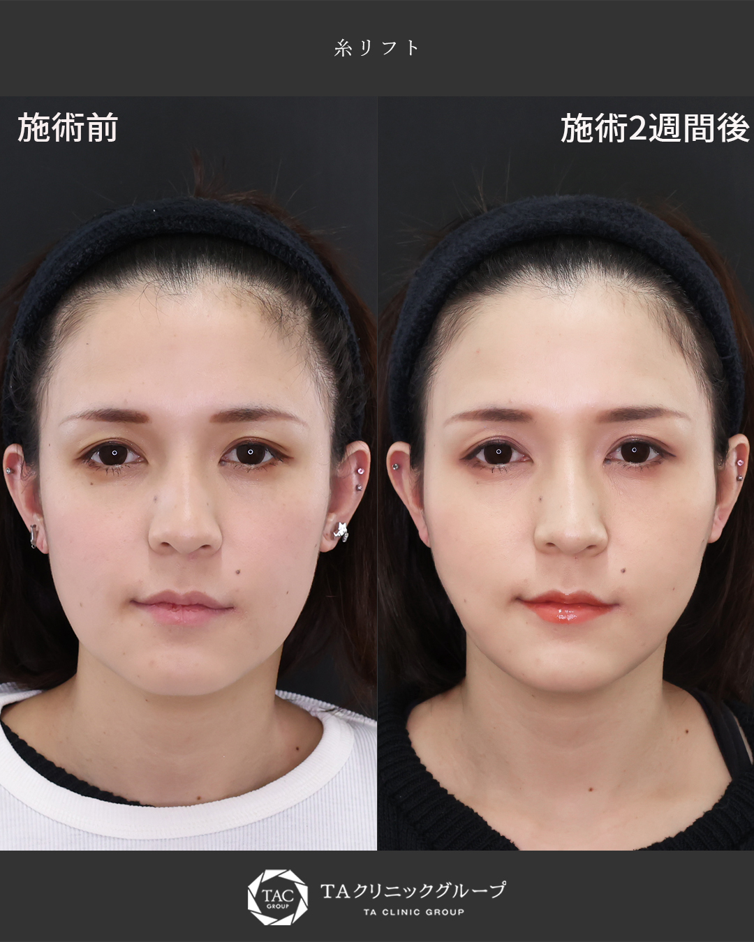 『糸リフト』でたるみ改善