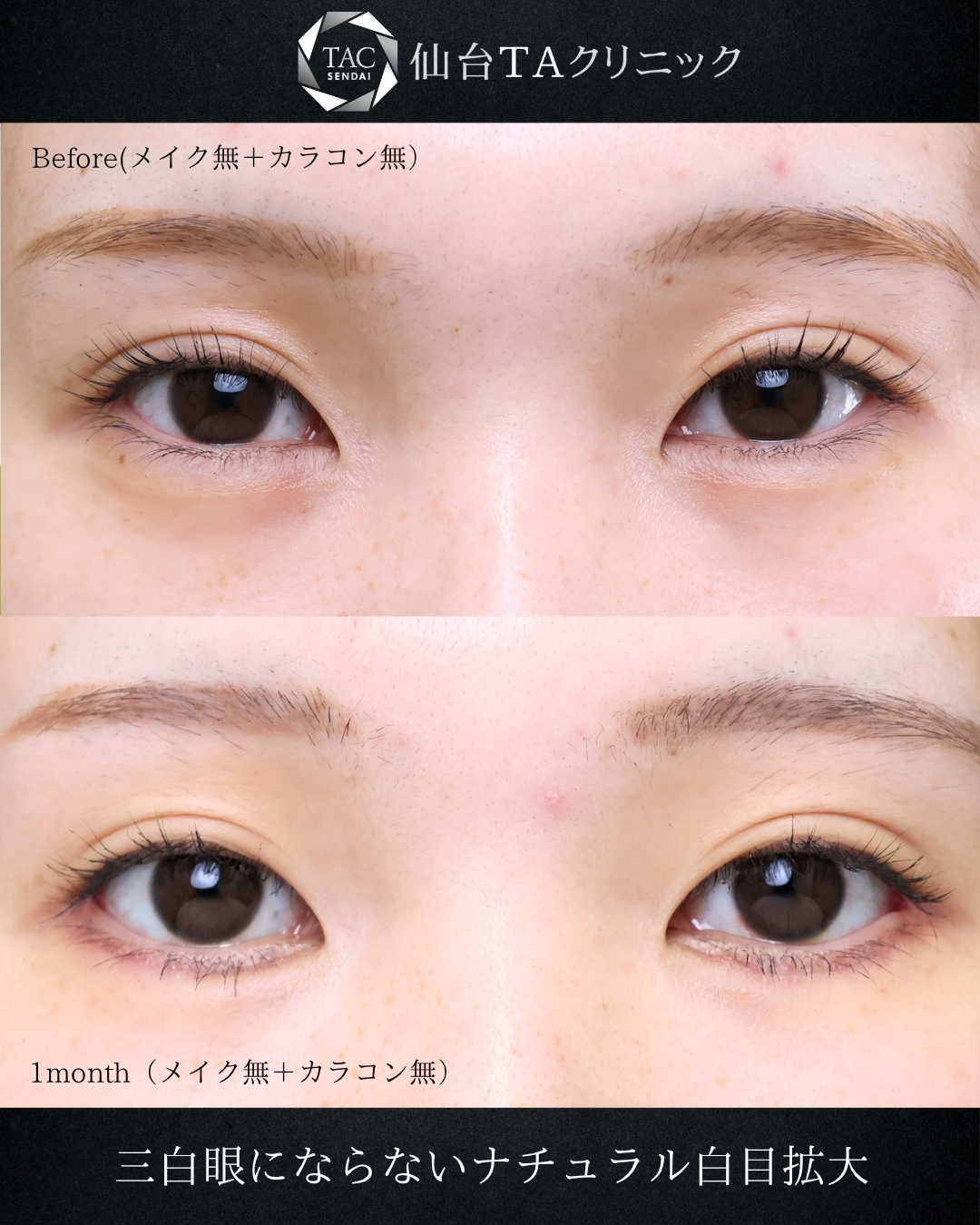 グラマラスライン（タレ目形成）/目尻切開術の症例写真 施術前後 