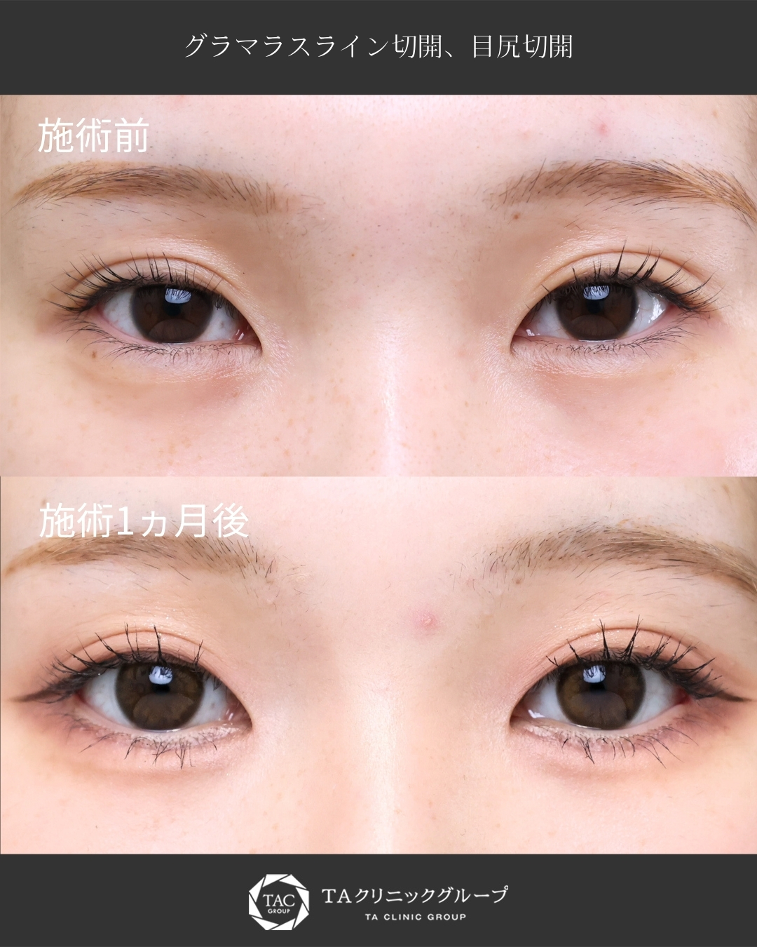 白目の範囲をナチュラルに増やす【タレ目形成＋目尻切開】