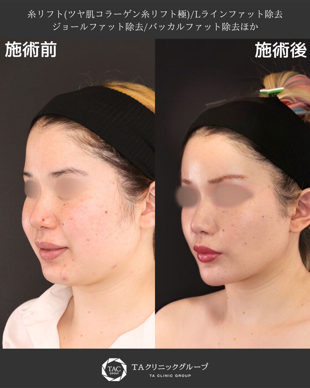 【山田真里江院長執刀】おでこからフェイスライン徹底改善オーダーメイド小顔術