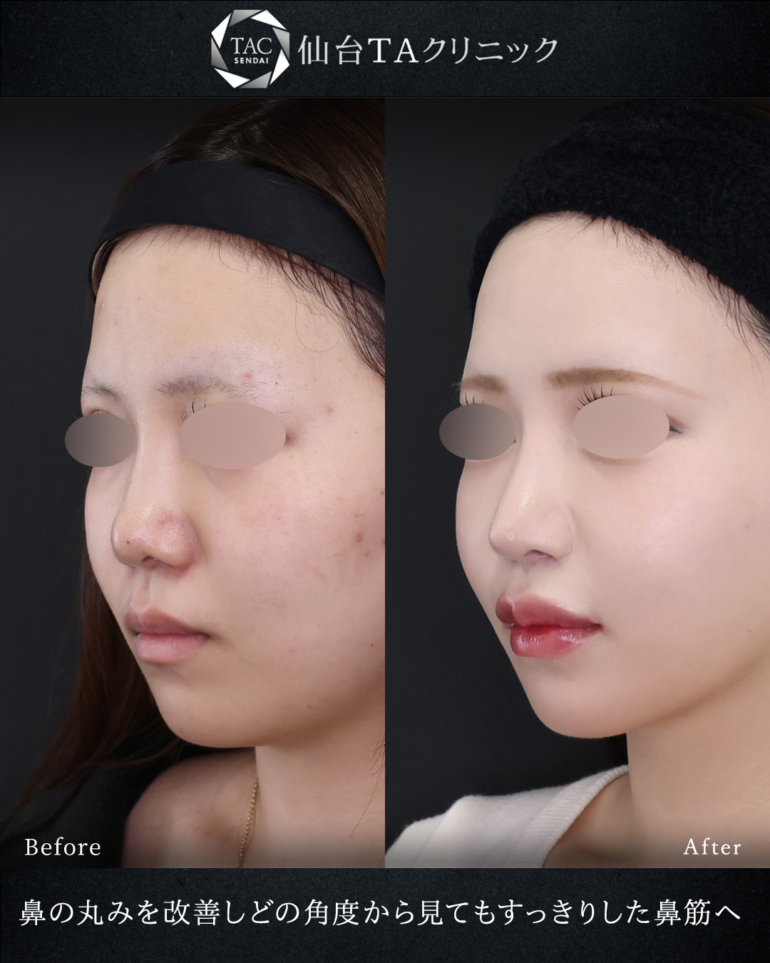 鼻中隔延長術/鼻尖形成・鼻尖縮小/TAC式 鼻翼縮小術（小鼻縮小）の症例写真 施術前後 