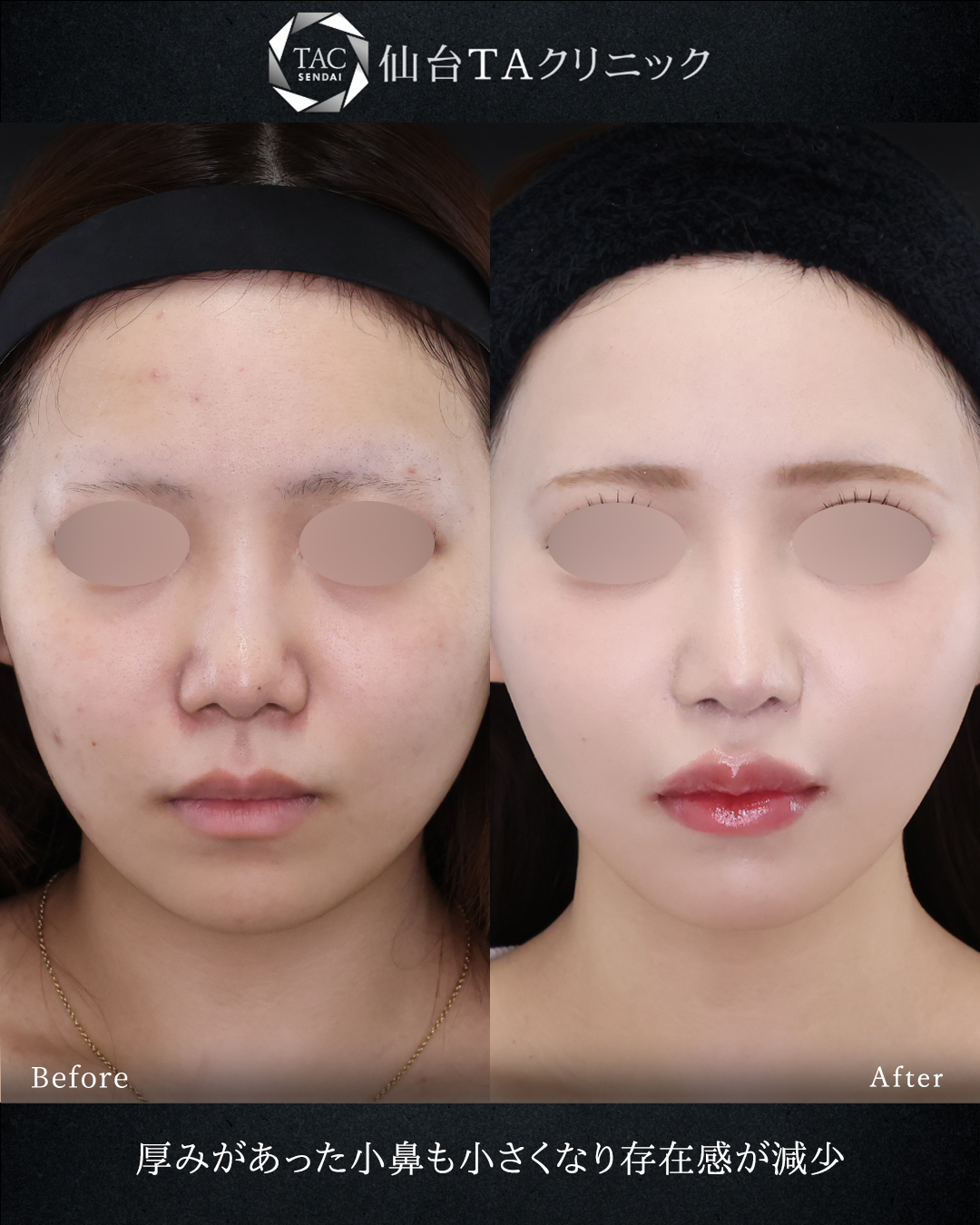 鼻中隔延長術/鼻尖形成・鼻尖縮小/TAC式 鼻翼縮小術（小鼻縮小）の症例写真 施術前後 