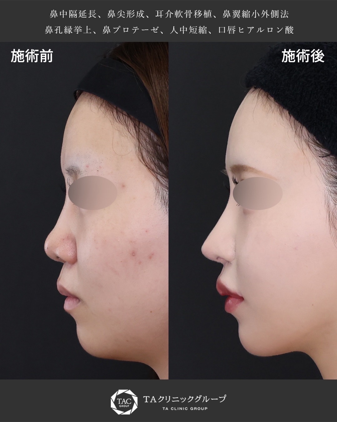 憧れの横顔に生まれ変わる『鼻フル整形』