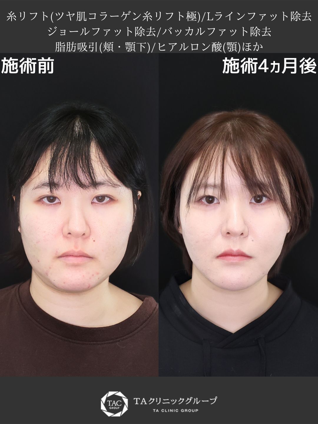 【堂脇医師執刀】糸リフト+脂肪吸引で小顔革命!輪郭スッキリで垢抜けフェイスに
