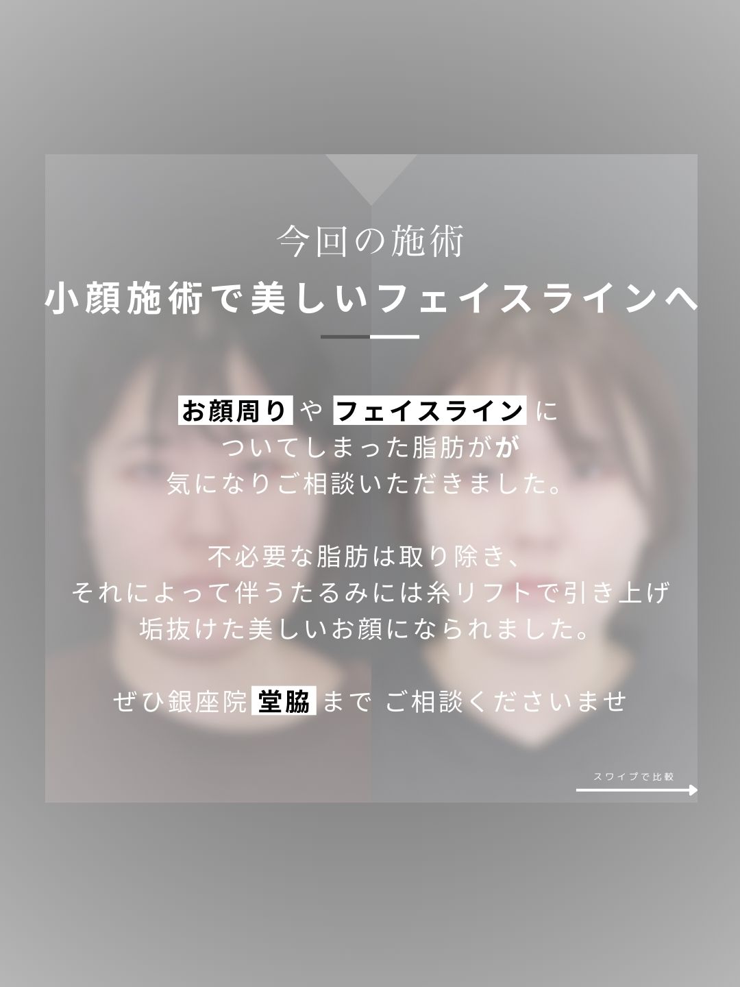 TAC式 ツヤ肌コラーゲンリフト®/Lラインファット除去（エラ下脂肪除去）/ジョールファット除去の症例写真 施術前後 