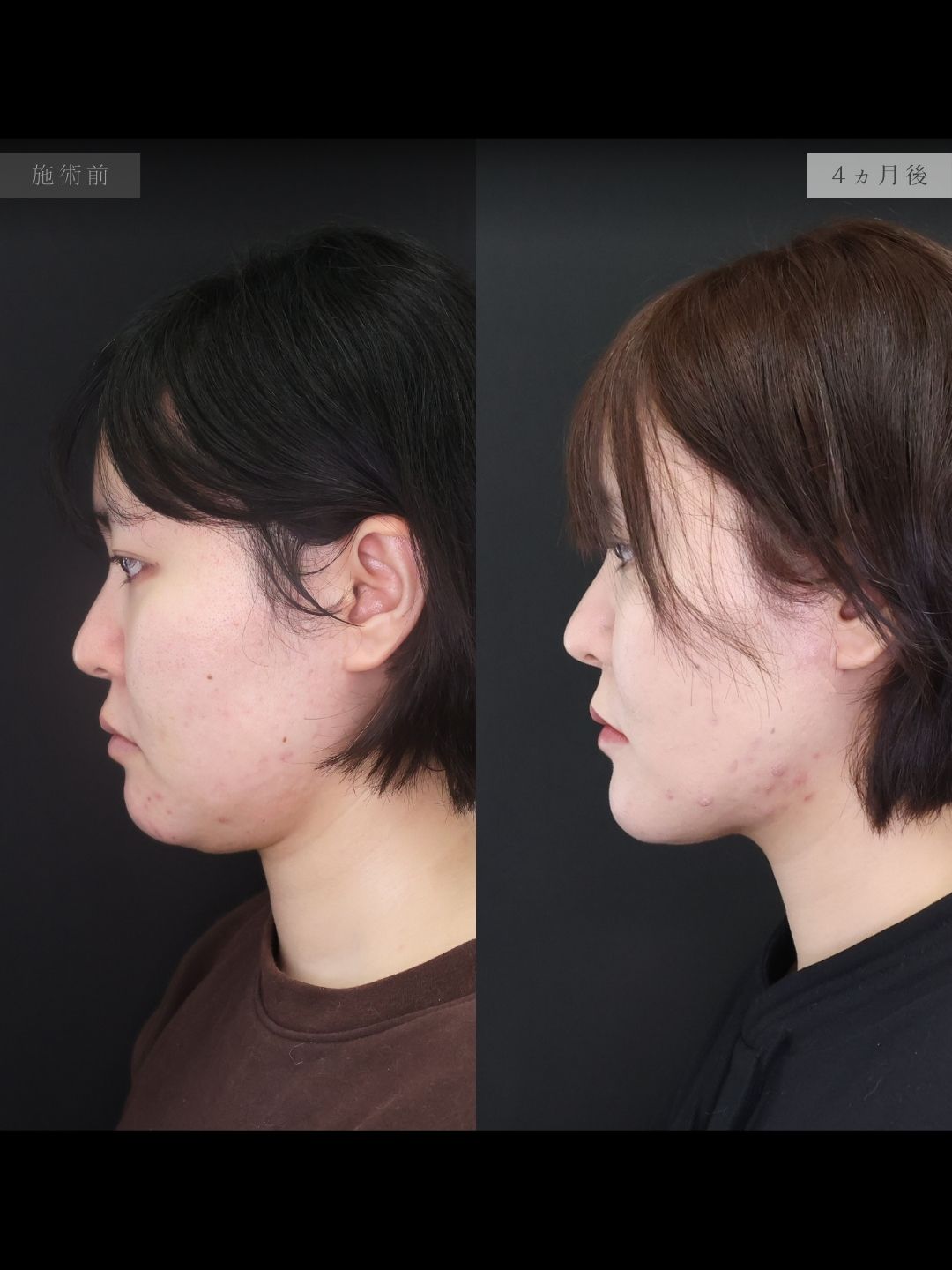 TAC式 ツヤ肌コラーゲンリフト®/Lラインファット除去（エラ下脂肪除去）/ジョールファット除去の症例写真 施術前後 