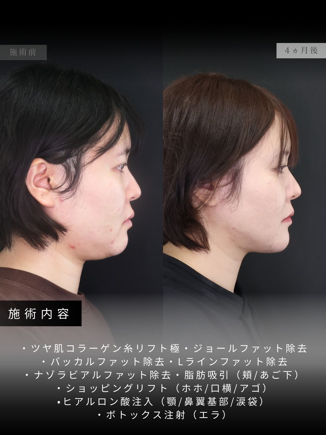 TAC式 ツヤ肌コラーゲンリフト®/Lラインファット除去（エラ下脂肪除去）/ジョールファット除去の症例写真 施術前後 