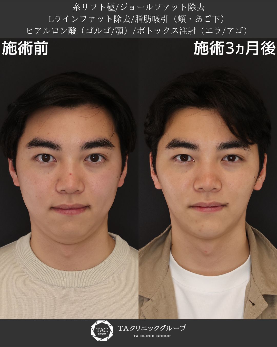 【堂脇医師執刀】脱・丸顔！小顔男子への第一歩