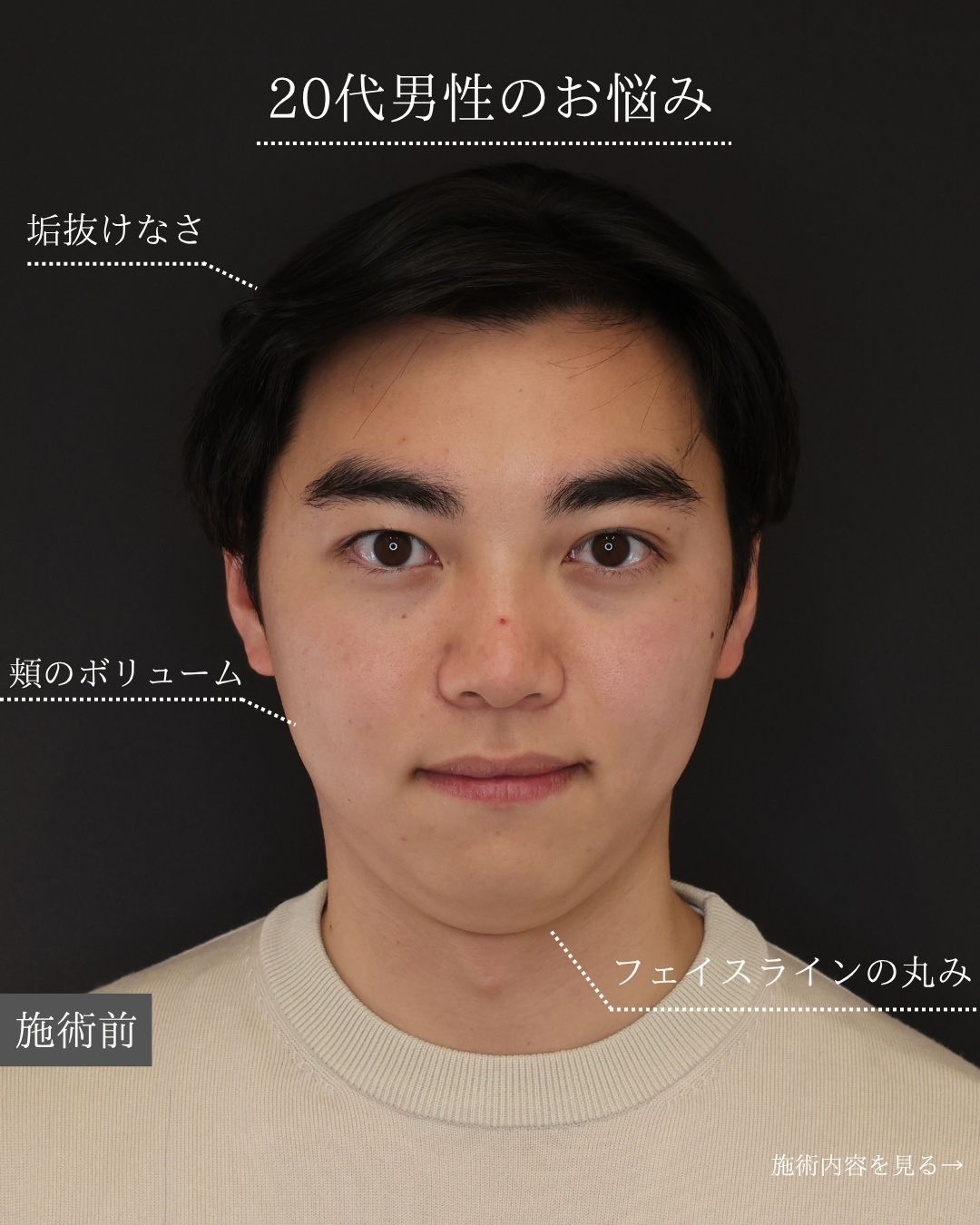 エラボトックス注射/ジョールファット除去/顎下の脂肪吸引の症例写真 施術前後 