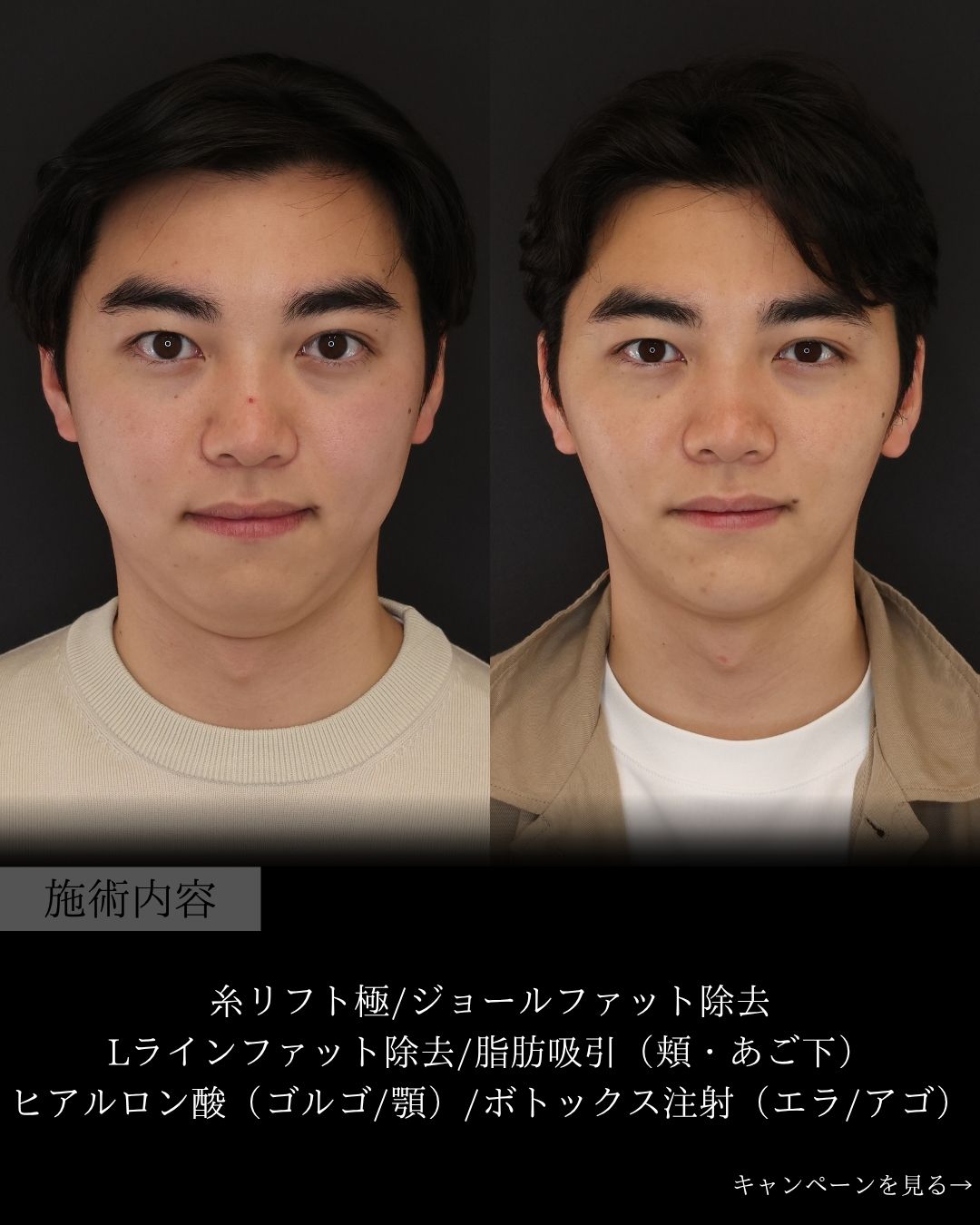 エラボトックス注射/ジョールファット除去/顎下の脂肪吸引の症例写真 施術前後 