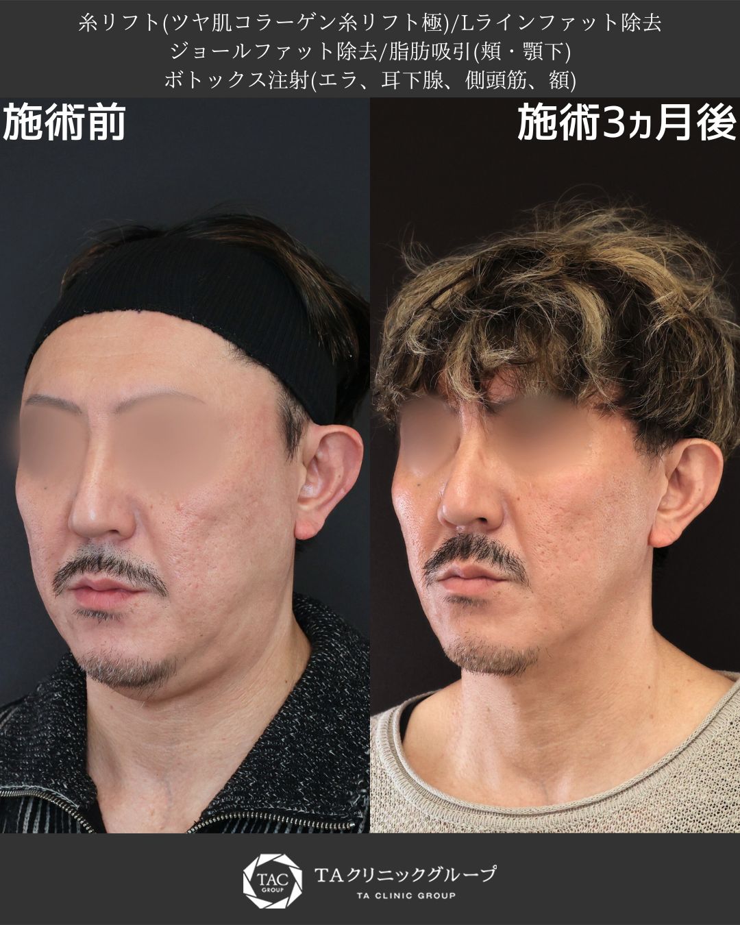 【堂脇医師執刀】「バレずに若返る。40代からのメンズ美容整形」