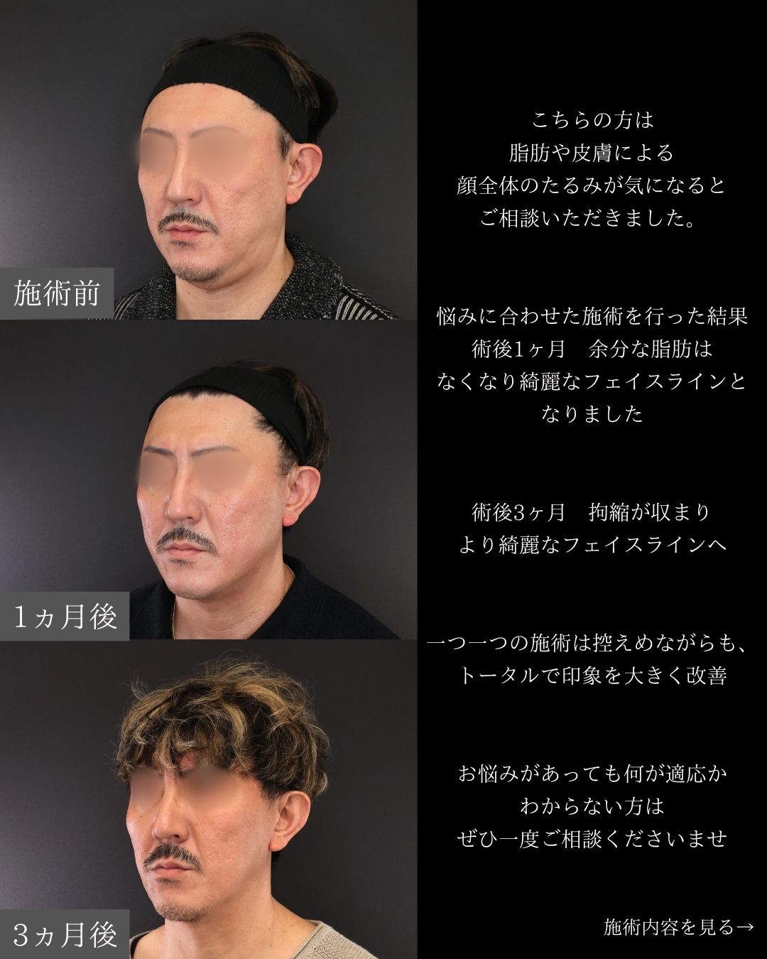 TAC式 ツヤ肌コラーゲンリフト®/Lラインファット除去（エラ下脂肪除去）/ジョールファット除去の症例写真 施術前後 