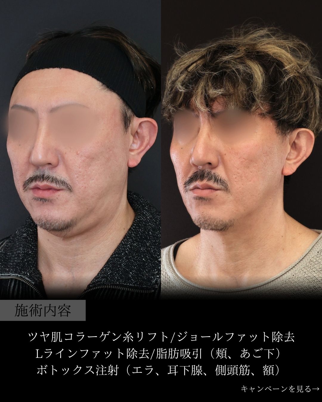 TAC式 ツヤ肌コラーゲンリフト®/Lラインファット除去（エラ下脂肪除去）/ジョールファット除去の症例写真 施術前後 