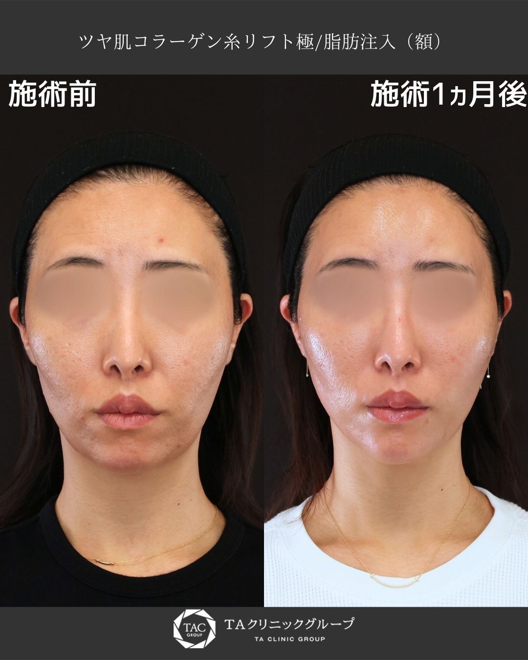 【形成外科専門医　藤橋医師執刀】糸リフト×脂肪注入で、ツヤとハリのある若々しいお肌へ