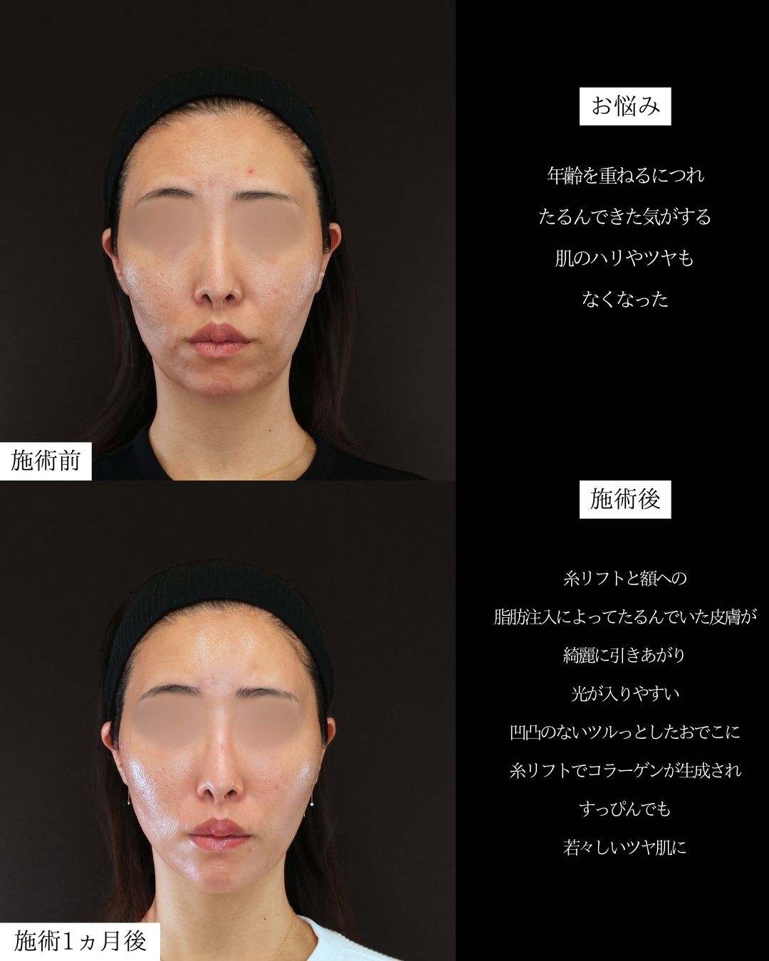 TAC式 ツヤ肌コラーゲンリフト®/顔の脂肪注入(コンデンスリッチフェイス)/おでこの脂肪注入（オルチャンデコ形成）の症例写真 施術前後 
