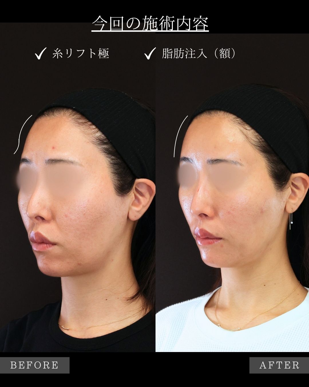 TAC式 ツヤ肌コラーゲンリフト®/顔の脂肪注入(コンデンスリッチフェイス)/おでこの脂肪注入（オルチャンデコ形成）の症例写真 施術前後 