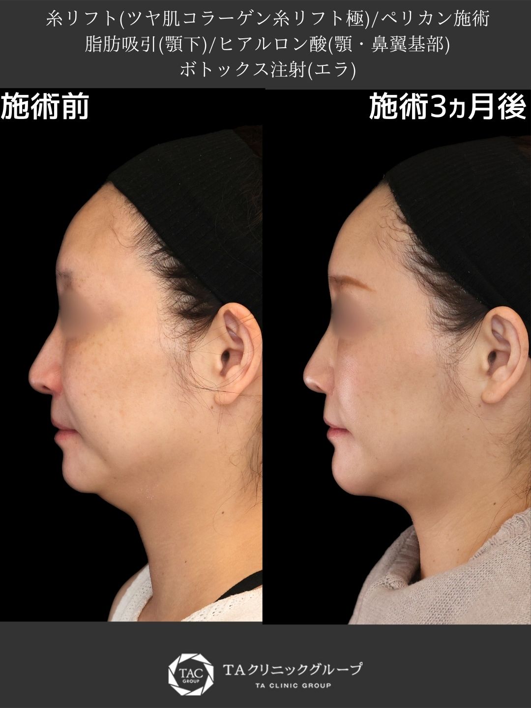 【フェイスライン徹底改善】形成外科専門医による糸リフト×ペリカン施術