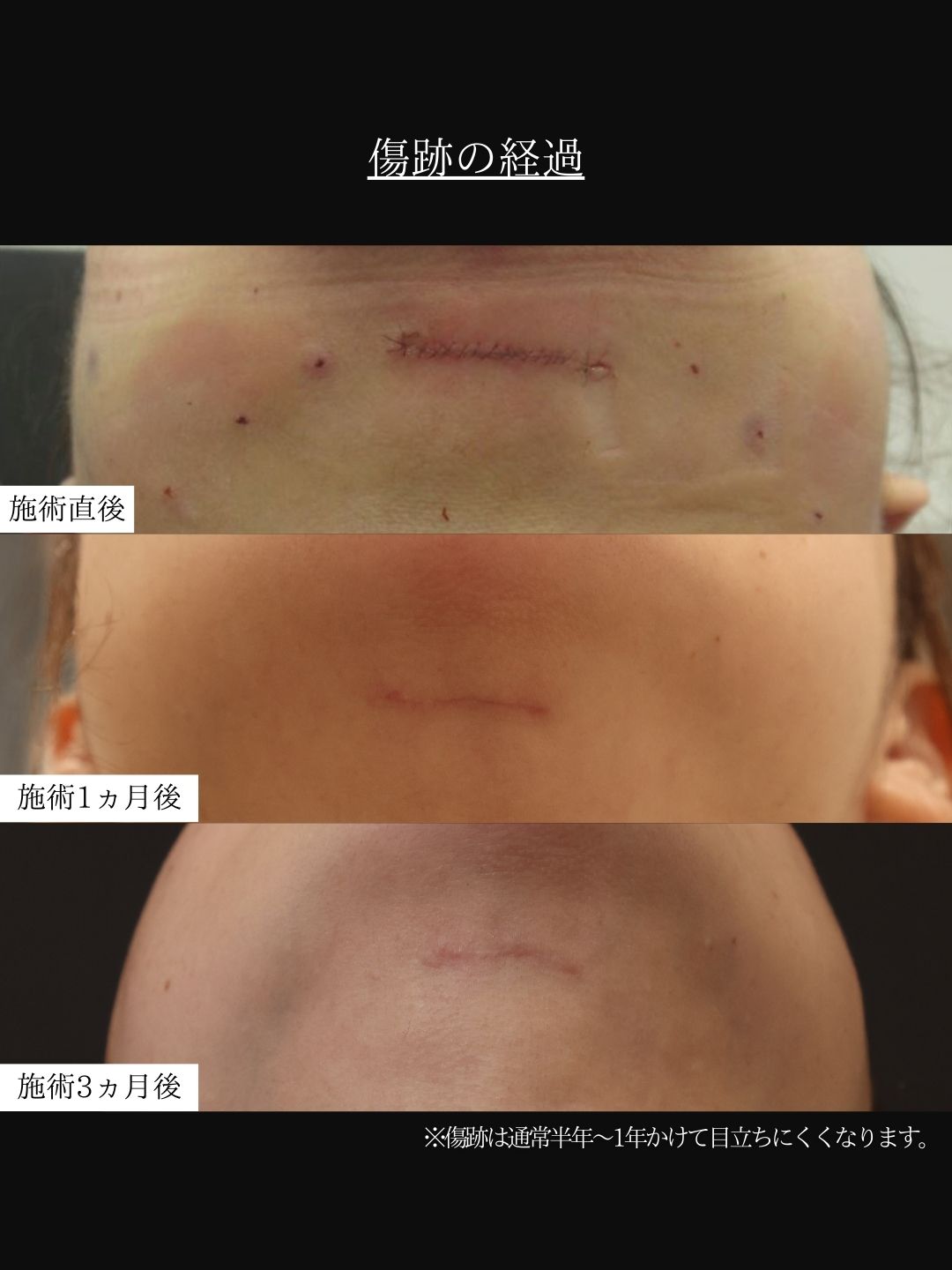 TAC式 ツヤ肌コラーゲンリフト®/顔の脂肪吸引/顎のヒアルロン酸注射の症例写真 施術前後 