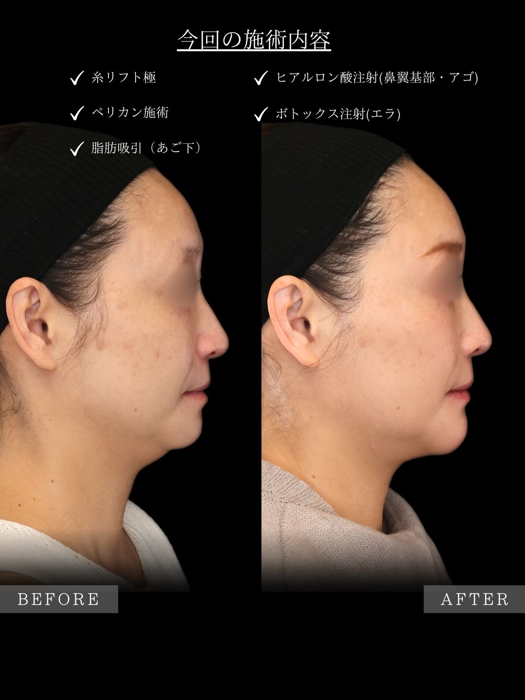 TAC式 ツヤ肌コラーゲンリフト®/顔の脂肪吸引/顎のヒアルロン酸注射の症例写真 施術前後 