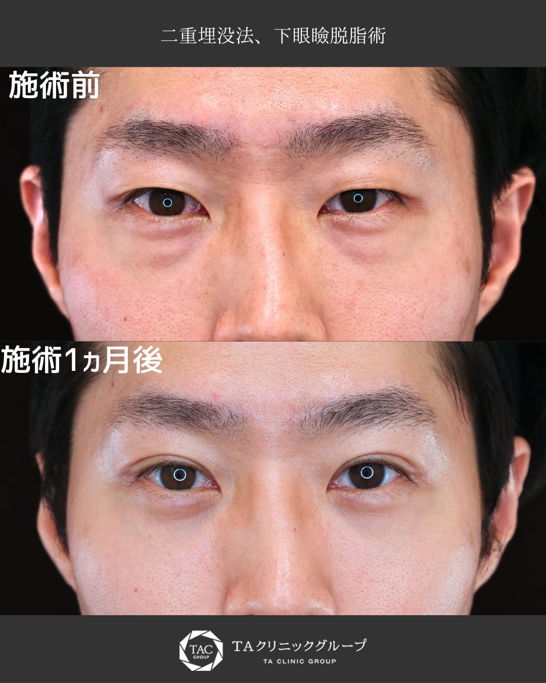 たった1時間で印象激変！二重埋没×クマ取り症例