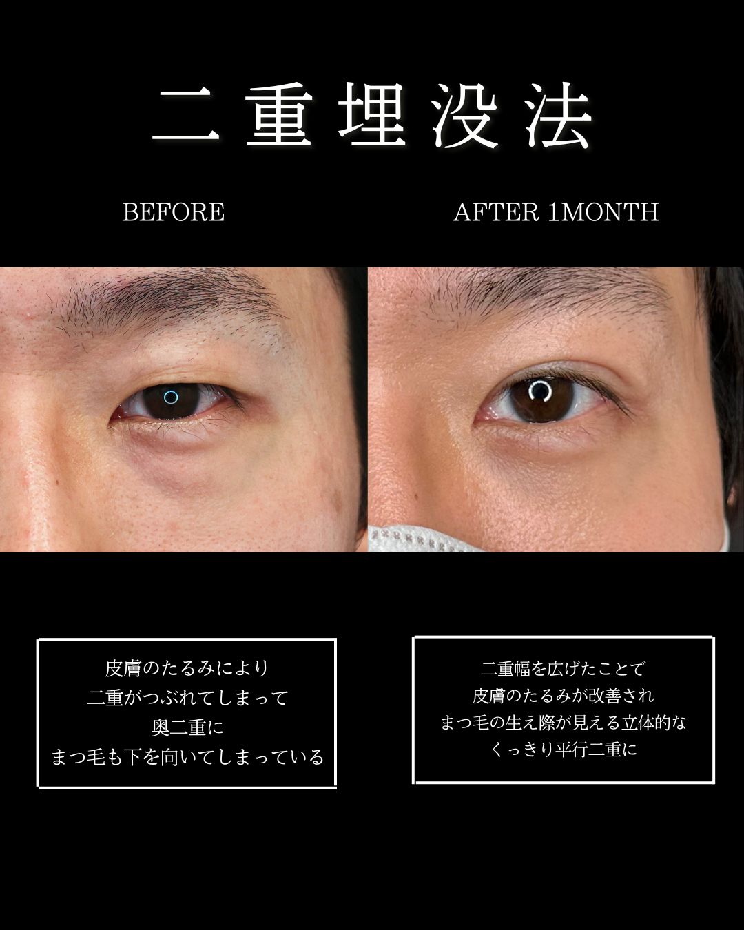 下眼瞼切開術（クマ・たるみとり）/下眼瞼脱脂術（目の下のたるみ取り・目の下の脂肪ふくらみ取り）/二重埋没法の症例写真 施術前後 