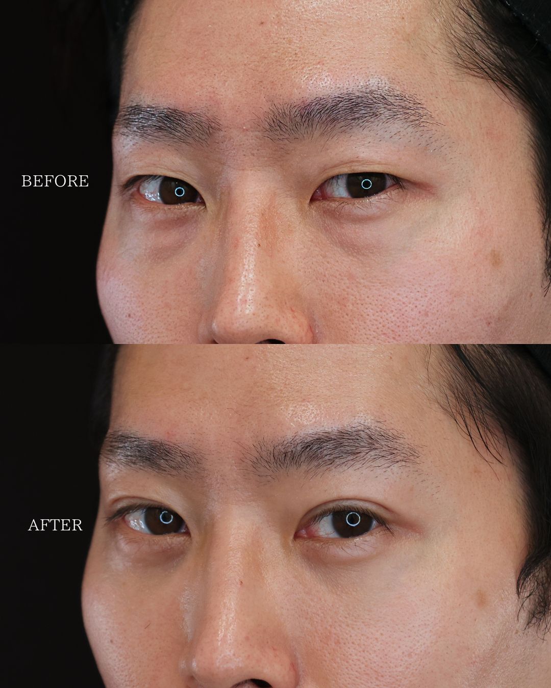 下眼瞼切開術（クマ・たるみとり）/下眼瞼脱脂術（目の下のたるみ取り・目の下の脂肪ふくらみ取り）/二重埋没法の症例写真 施術前後 