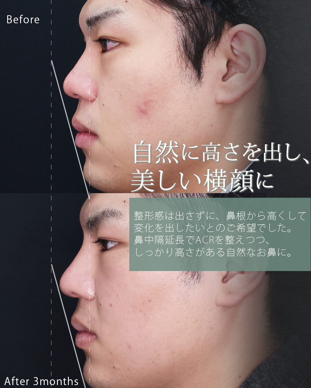 鼻中隔延長術/鼻尖形成・鼻尖縮小/隆鼻術（プロテーゼ・自家組織）の症例写真 施術前後 