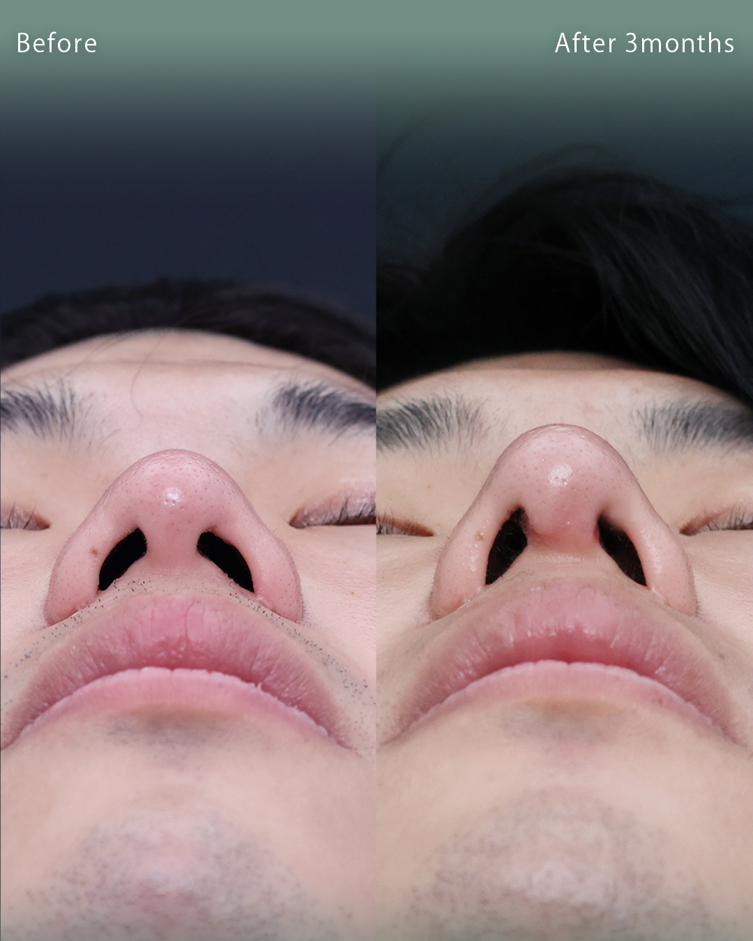 鼻中隔延長術/鼻尖形成・鼻尖縮小/隆鼻術（プロテーゼ・自家組織）の症例写真 施術前後 