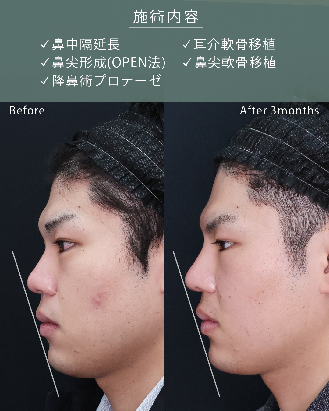 鼻中隔延長術/鼻尖形成・鼻尖縮小/隆鼻術（プロテーゼ・自家組織）の症例写真 施術前後 
