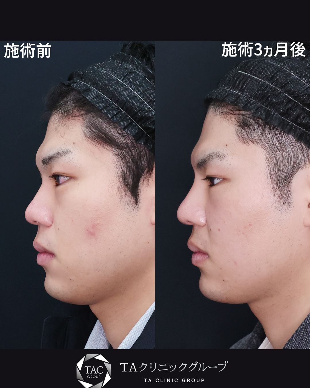 【メンズ鼻整形】鼻中隔延長で整形感を出さずに確実な変化を