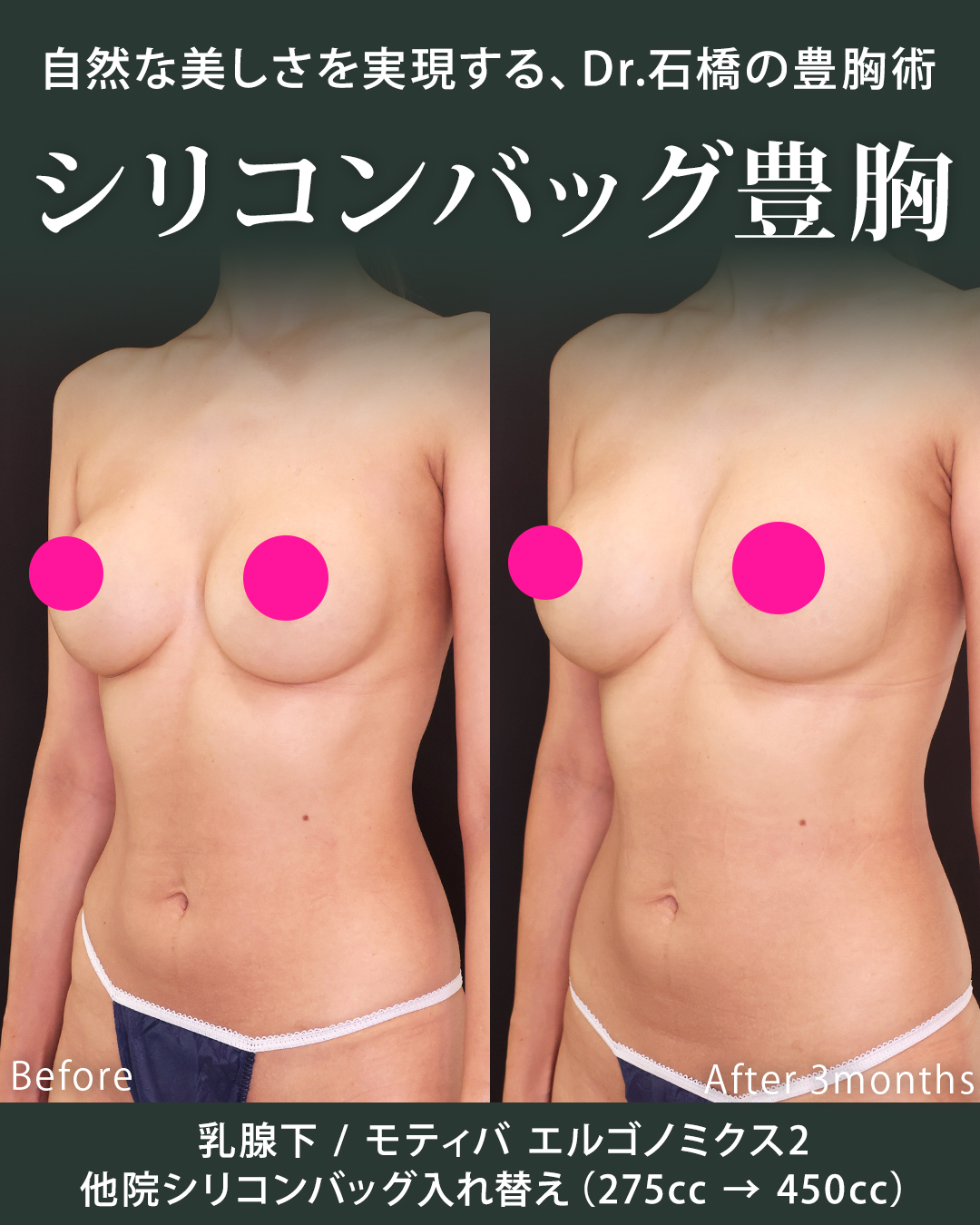 シリコンバッグ豊胸（人工乳腺バッグ）の症例写真 施術前後 