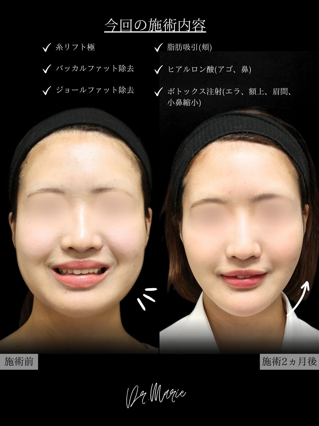 TAC式 ツヤ肌コラーゲンリフト®/ジョールファット除去/バッカルファット除去の症例写真 施術前後 