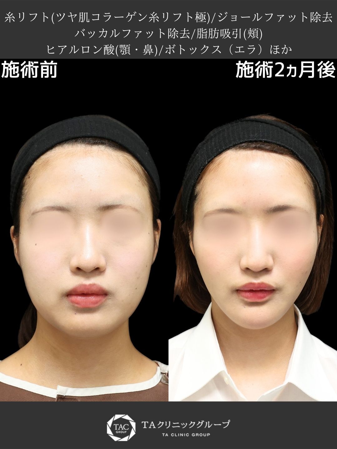 【山田真里江院長執刀】“まる顔”卒業！糸リフト×脂肪吸引でVラインフェイス
