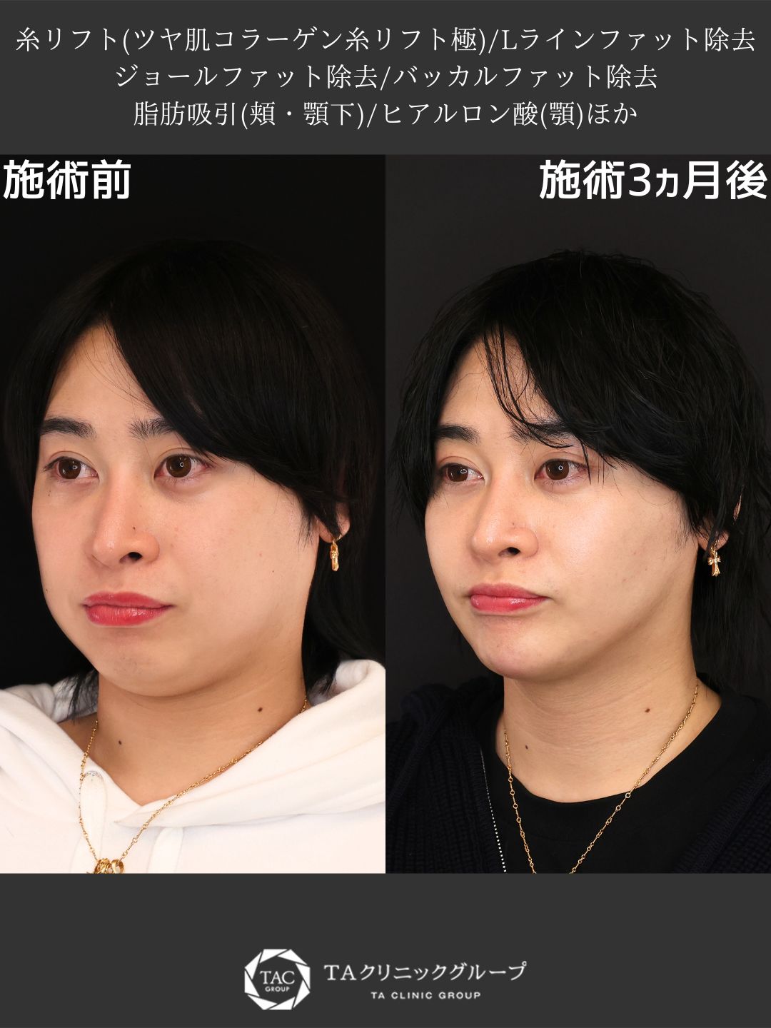 【Dr.Marieのオーダーメイド小顔術】脂肪除去×糸リフトで叶える理想のVラインフェイス