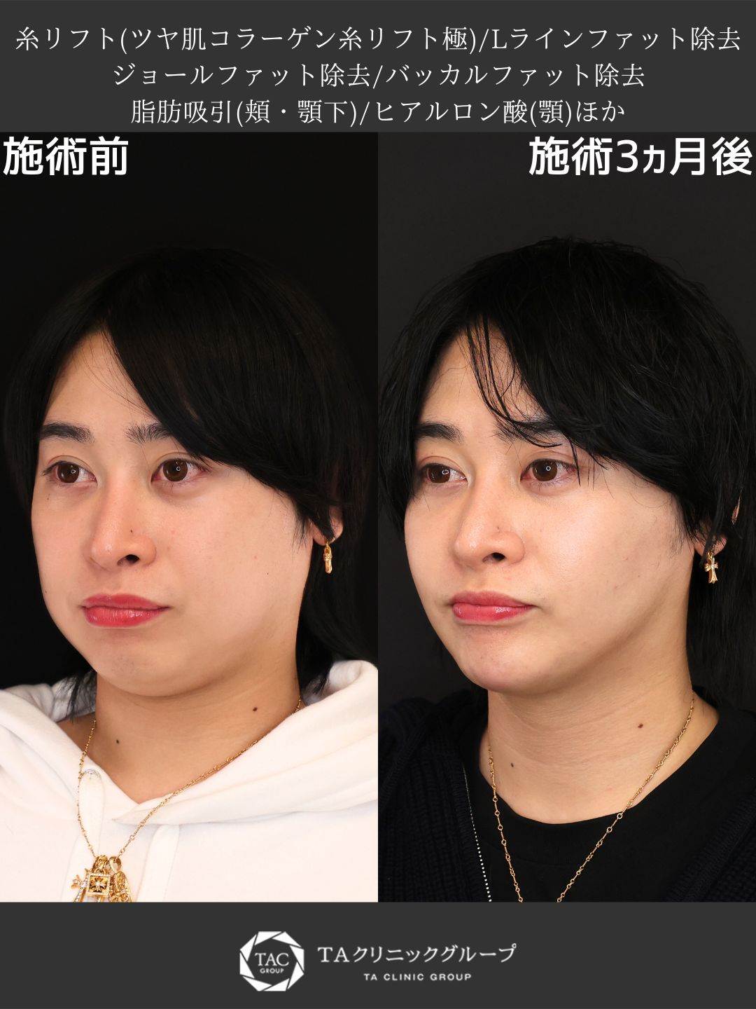 【Dr.Marieのオーダーメイド小顔術】脂肪除去×糸リフトで叶える理想のVラインフェイス