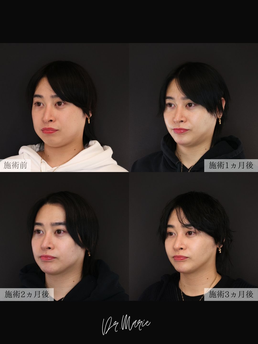 バッカルファット除去/ジョールファット除去/顔の脂肪吸引の症例写真 施術前後 