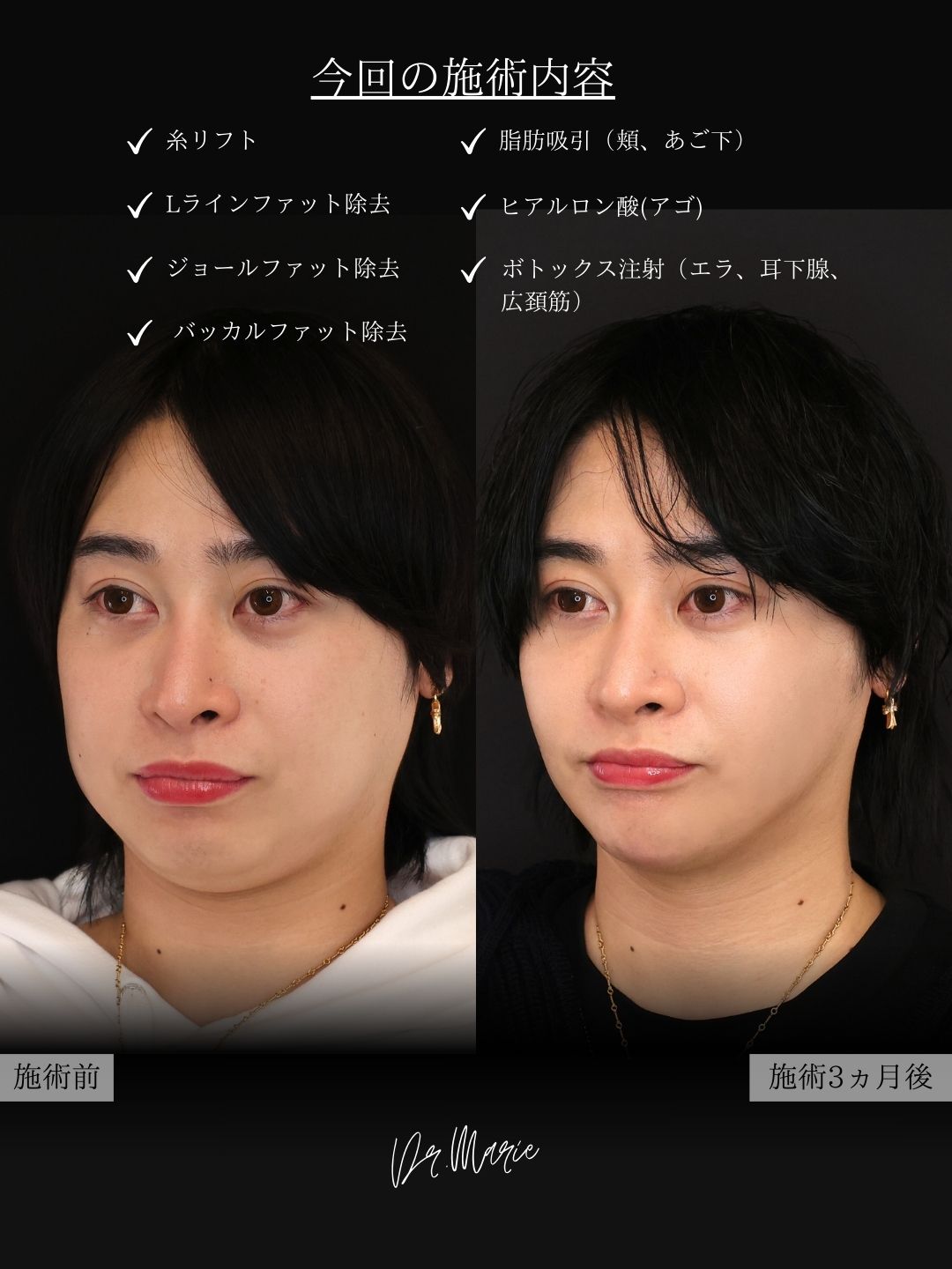 バッカルファット除去/ジョールファット除去/顔の脂肪吸引の症例写真 施術前後 