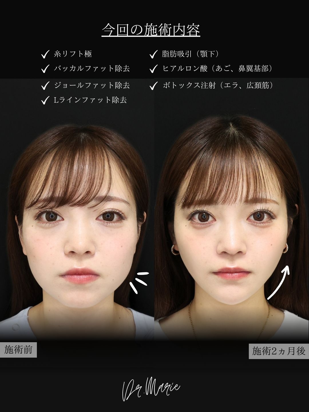 TAC式 ツヤ肌コラーゲンリフト®/バッカルファット除去/ジョールファット除去の症例写真 施術前後 