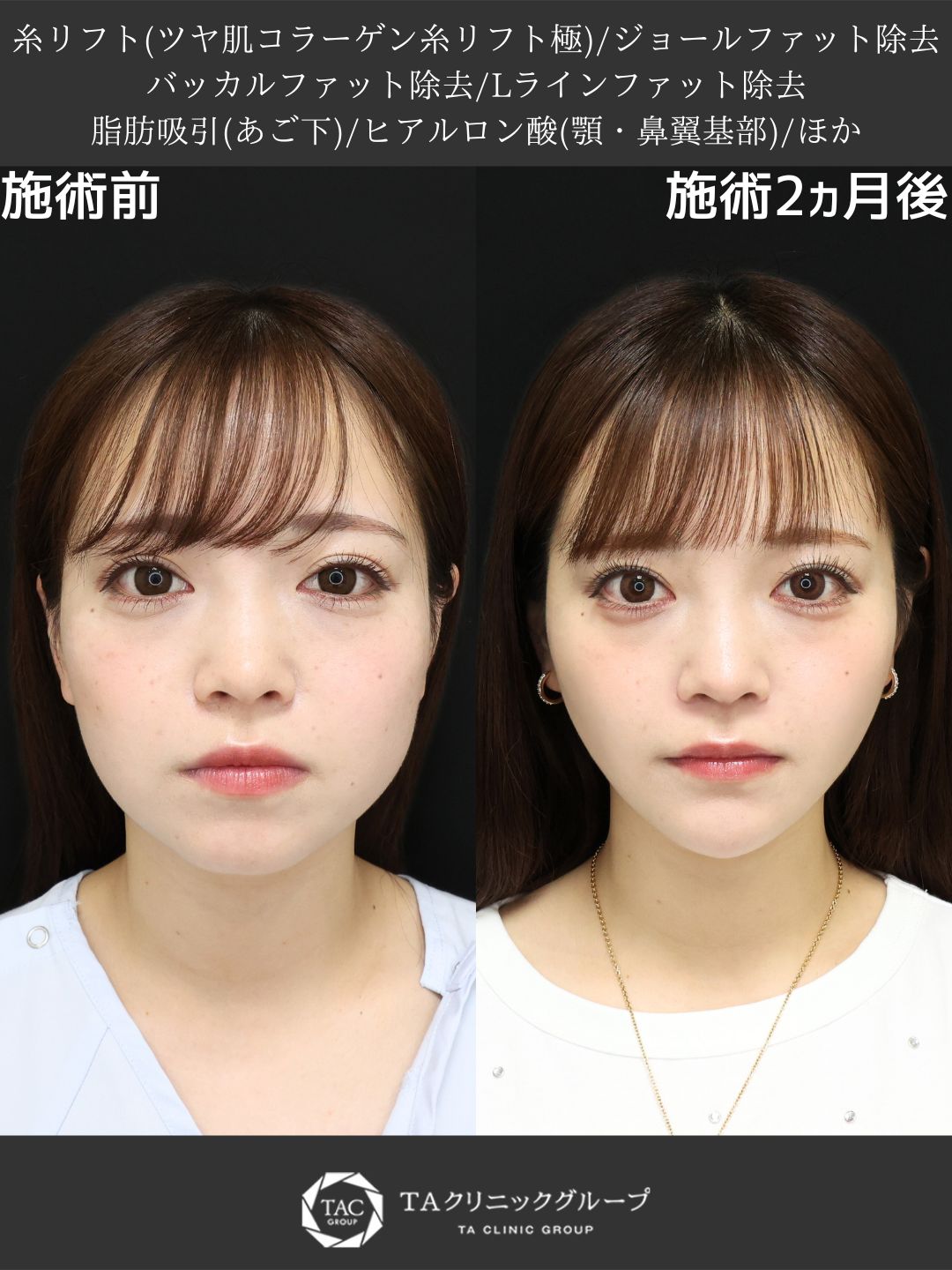 脂肪除去＋リフトで理想のVラインへ － Dr.MARIE式トータル小顔術