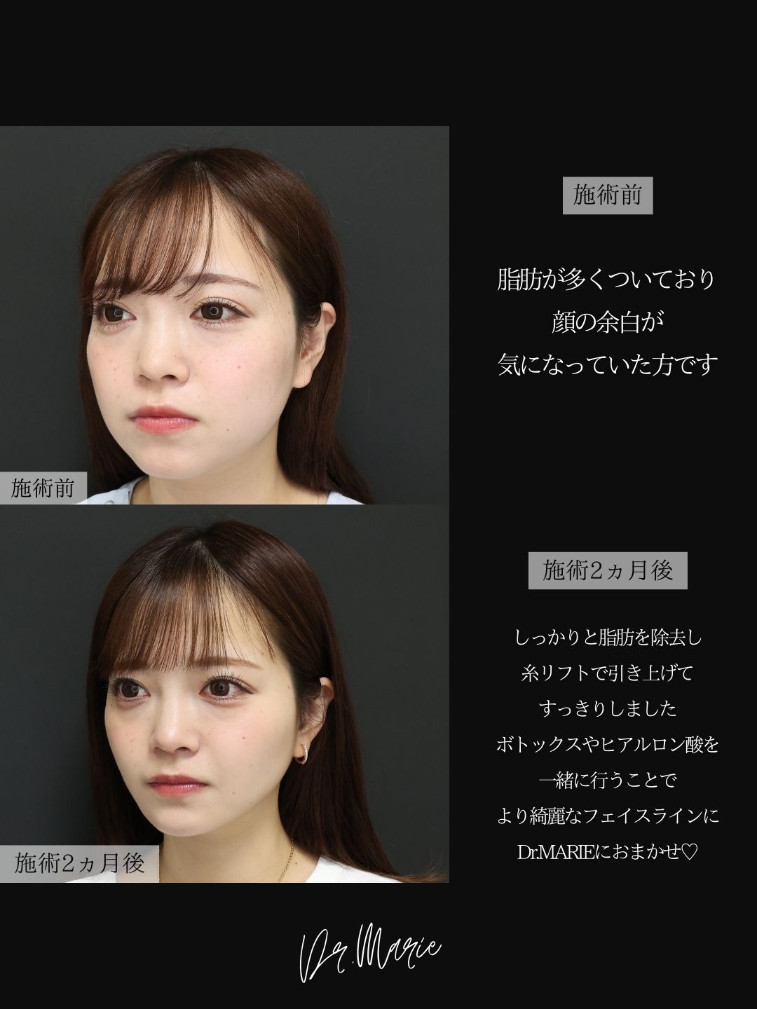 TAC式 ツヤ肌コラーゲンリフト®/バッカルファット除去/ジョールファット除去の症例写真 施術前後 