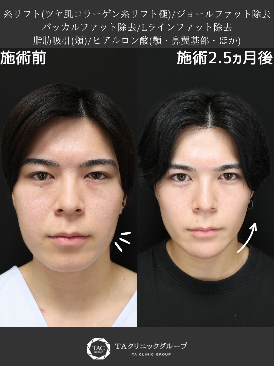 【Dr.Marieの小顔革命】糸リフト＆脂肪吸引でシャープな輪郭へ